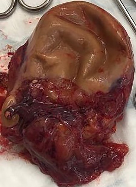 Resected mucinous appendiceal adenocarcinoma with areas of LAMN and HAMN.