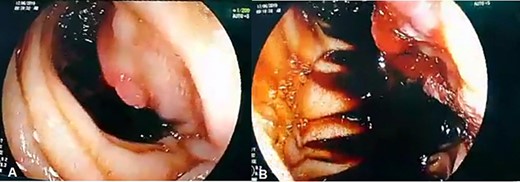(A, B) Upper GI endoscopy shows centrally ulcerated recurrent tumor in the third portion of the duodenum with active bleeding.