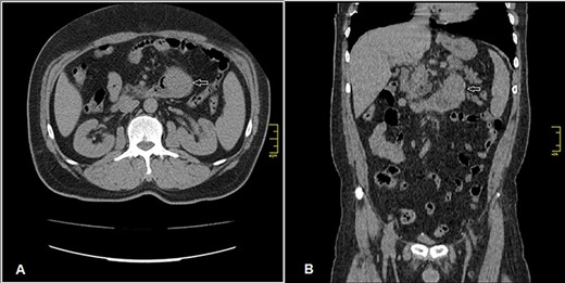 Enhanced CT scan (A) axial section and (B) coronal section: shows well enhanced mass 5 × 4.5 cm (arrow) at previous duodenojejunal anastomosis without intraperitoneal or liver metastasis.