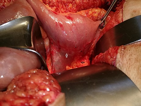 Recurrent tumor on the previous (end-side) duodenojejunal anastomosis (white arrow) and pancreas (black arrow).