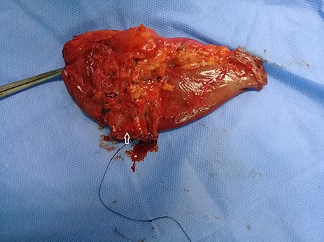 Limited resection of the distal third part of the duodenum (white arrow) with proximal jejunum including the mass (black arrow).
