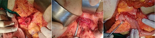 (A) The cut end of the distal third portion of the duodenum (arrow). (B) The closed end of the distal third portion of the duodenum (arrow). (C) Side-to-side anastomosis between the second duodenal portion and jejunum (white arrow), the site of previous feeding jejunostomy tube (black arrow).