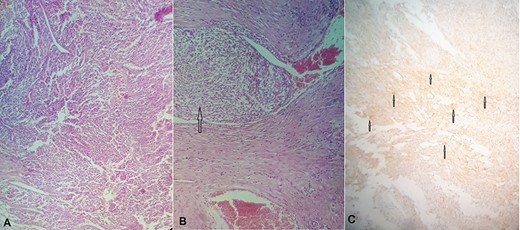 (A) Hematoxylin and eosin (H&E) stain: proliferation of spindle cells of varying cellularity, hyperchromasia and nuclear pleomorphism (GIST spindle cell type). (B) H&E stain: vascular invasion with tumor emboli (arrow). (c): Immunohistochemical staining for CD117 is positive (arrows).