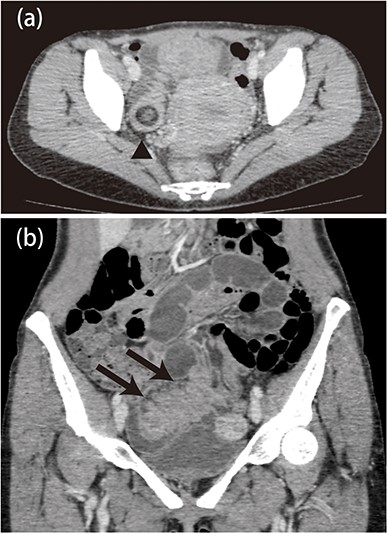 a: Abdominal computed tomography image showing an edematous and thickened ileum with advanced intussusception of the fat tissue. b: There was mild dilatation of the proximal side of the ileum, but no ischemic changes in the intestines.