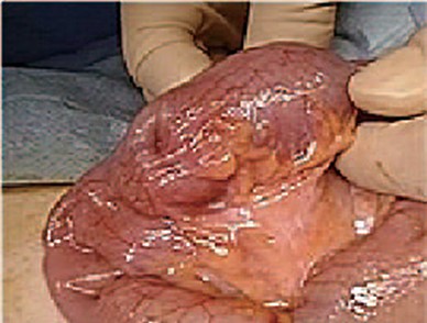 Intraoperative findings. Approximately 8 cm of the ileum was resected, including a mass lesion, which was palpated in the 50 cm ileum from a terminal ileum.