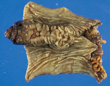 Meckel’s diverticulum was inverted and appeared as a polypoid lesion protruding toward the gut lumen. In addition, erosion was observed in the front and side of the diverticulum.