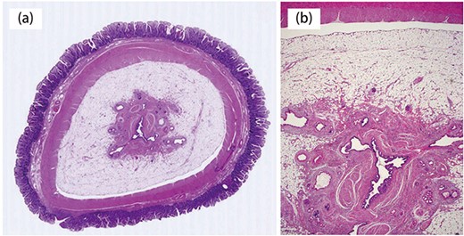 Histopathological findings. a:Diverticulum was a true diverticulum (hematoxylin and eosin stain). b: Specimen showing a high columnar, mucous epithelium; a mucous gland and insular colonization in the tip of the diverticulum.