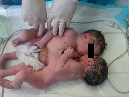 Omphalopagus twins at birth.