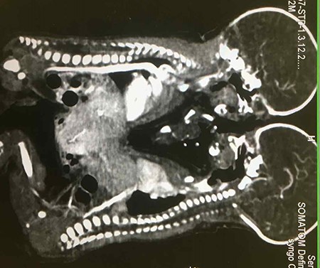 A contrast CT scan showing differential enhancement of livers of both twins and pulled vena cava for left twin.