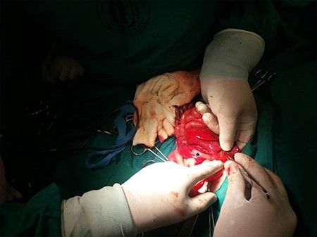 Intraoperative view: connecting part of liver between twins, asterisk represents right twin’s gall bladder.