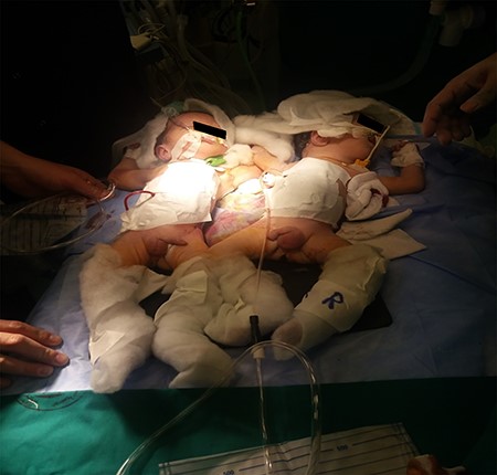 Postoperative: twins at end of separation.