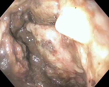 Esophagogastroduodenoscopy showing necrotic mucosa over the greater curvature of the stomach on retroflex view