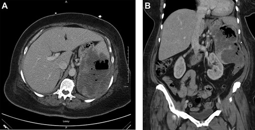 (a) Axial view of CT scan with intravenous contrast showed gastrocolic fistula. (b) Coronal view of contrast-enhanced abdominal CT scan. Large splenic mass fistulating into stomach and colon