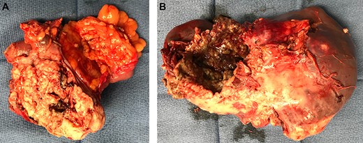 (a) Specimen showing gastrosplenocolic fistula. (b) Lateral side of spleen shows splenocolic fistula