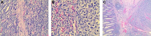 Histopathological slides showing specimen of stomach, spleen and colon. Atypical lymphoma cell were found in each organ specimen on hematoxylin–eosin stain. (a) Hematoxylin–eosin stain of the stomach specimen (benign tissue on the left and lymphoma on the right). (b) Hematoxylin–eosin stain of the spleen specimen (benign tissue on the left and lymphoma on the right). (c) Hematoxylin–eosin stain of the colon specimen
