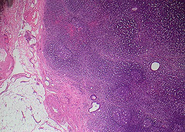 Endosalpingiosis (low-power view ×x40)