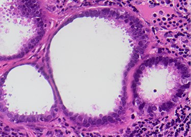 Endosalpingiosis (high-power view ×400)