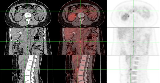 FDG avid aortocaval lymph node at the level of the right renal hilum (7 mm in short axis, SUVmax 5.9) on PET/CT