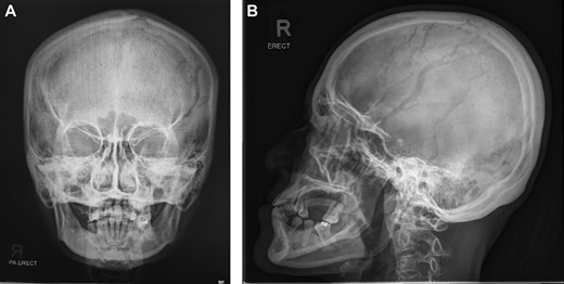A relatively normal X-ray skull which did not show any significant pathology.