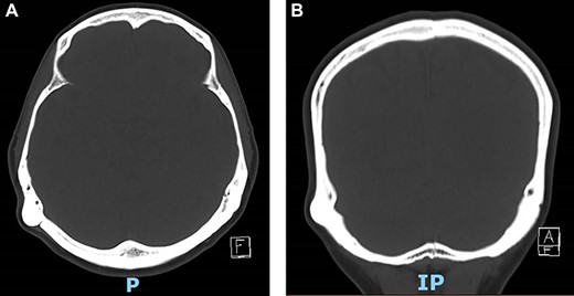 Computed tomography (CT) of temporal bone showing retro-mastoid osteoma in axial and coronal plane.