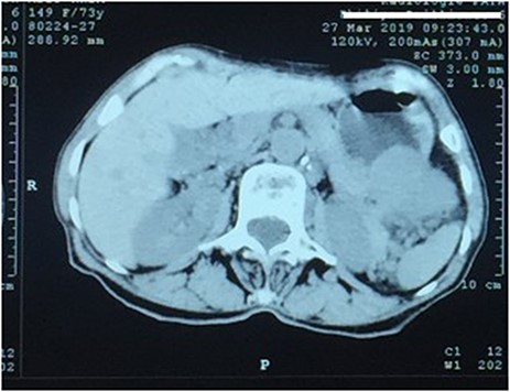 CT scan showing an exophytic mass in the great curvature of stomach wall