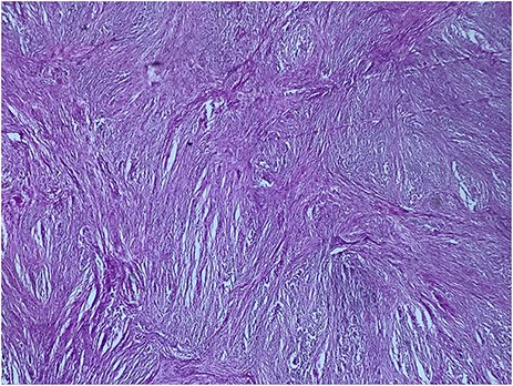 Biphasic proliferation of compact hypercellular areas and myxoid hypocellular areas (HE, G x 25)