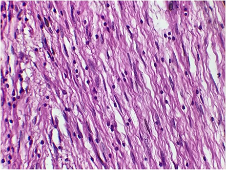 The tumor cells are narrow, elongated and wavy with tapered ends interspersed with collagen fibers (HE, G x 400)