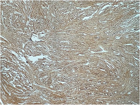 Strong S100+ immunoreactivity