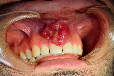Lesion at initial clinical presentation.
