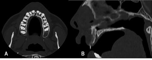 Maxillofacial CT scan, axial (A) and sagittal (B) images. Osteolytic lesion on the vestibular edge of the maxillary alveolar process, with 12 mm of craniocaudal dimension and 4 mm of axial dimension.