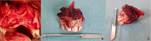 After en-bloc resection of the premaxilla (A). Frontal (B) and lateral (C) view of the surgical specimen.