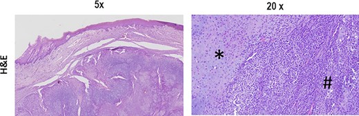 The typical biphasic pattern of MCS, composed of islands of cartilage (*) admixed with poorly differentiated small round cells with scant cytoplasm (#). H&E stain.