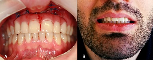 Rehabilitation with a removable partial denture (A). Frontal view after oral rehabilitation (B).