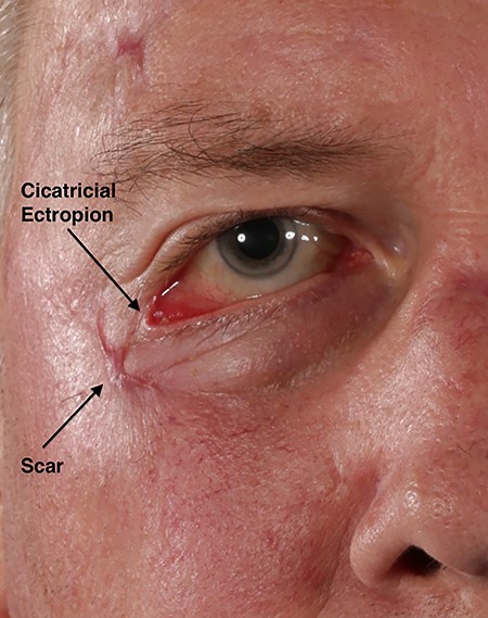A 2-month old scar involving the lower eyelid of the right eye causing cicatricial ectropion.