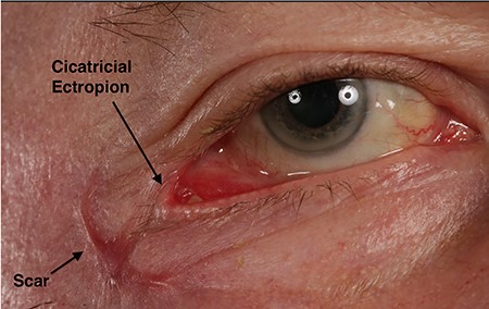 Close-up of a 2-month old scar involving the lower eyelid of the right eye causing cicatricial ectropion.