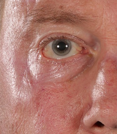 Post repair of cicatricial ectropion at rest.