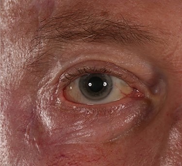 Close-up of post repair of cicatricial ectropion at rest.