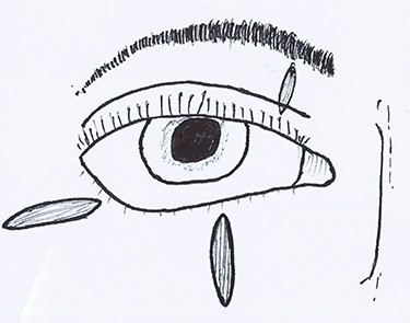 Ideal orientation of lacerations which have a lower risk of ectropion. Notice how the scar on this patient is perpendicular to the ideal.