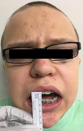 Preoperative maximal inter-incisal distance, approximately 8 mm.