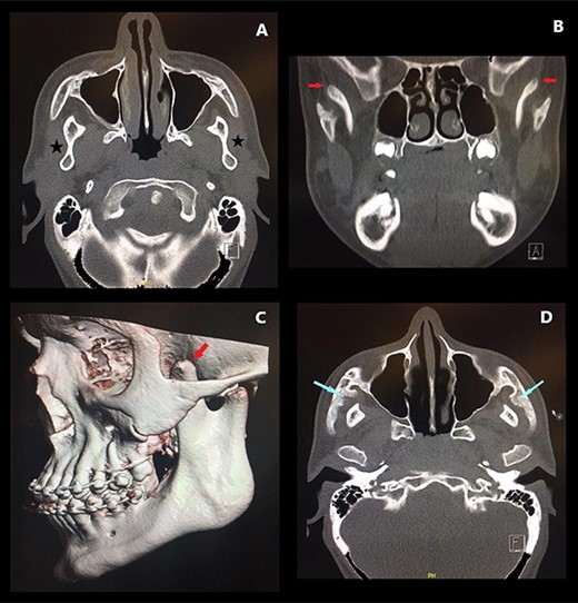 Preoperative CT ((A and D) axial sections, (B) coronal section, (C) 3D reconstruction) demonstrating CPH (red arrows), concavity of the ramus (stars) and bony deposits on the medial aspect of zygomatic arches (blue arrows).