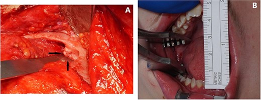 Intraoperative. (A) Superior view of left zygomatic arch, demonstrating exophytic bone on the anteromedial surface. (B) Mouth opening 40 mm.