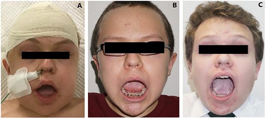 Postoperative progress. (A) Immediately post-op with bite block in situ. (B) 4 weeks post-op. (C) 18 months post-op.