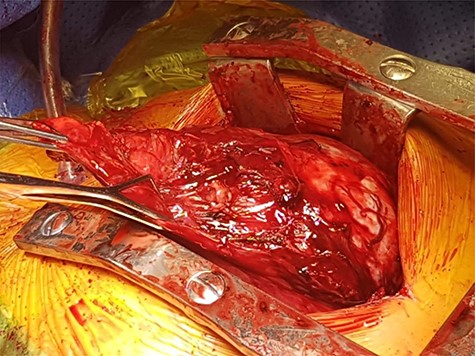 Mass in the anterior mediastinum.