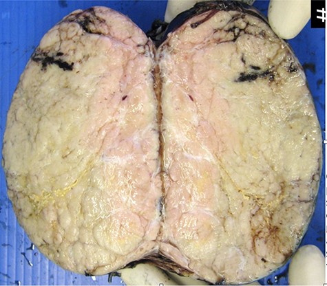 Macroscopic appearance of resected thymoma. Cut section is predominantly solid, homogenous cream in colour, with multilobated appearance separated by thin fibrous septa.