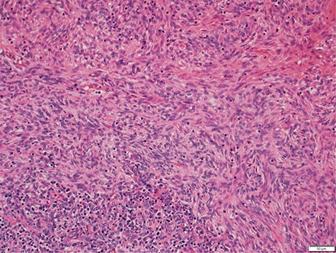 Photomicrograph showing medium magnification of type AB thymoma, composed of spindle cell component and lymphocyte component (biphasic tumour).