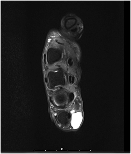axial MRI scan of the left hand showing the DPC at the level of the fifth MCP joint.