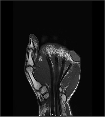 coronal MRI scan of the left hand showing the DPC at the level of the fifth MCP joint.