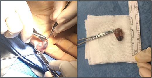 surgically excised DPC. The DPC lesion was excised from the ulnar aspect of the left palm at the level of the fifth MCP joint. The lesion was ~2 cm in diameter and well circumscribed with a dark brown gelatinous appearance.