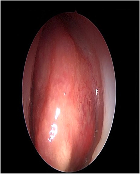 Nasal endoscopy image showing a bony mass attached to the left middle turbinate pushing the septum to the right.