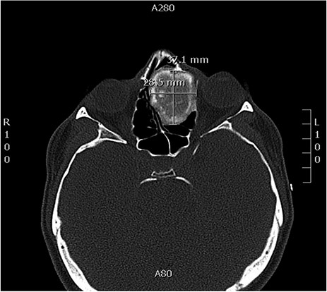 Axial CT image of the sinuses showing a mass filling the left ethmoidal sinus.
